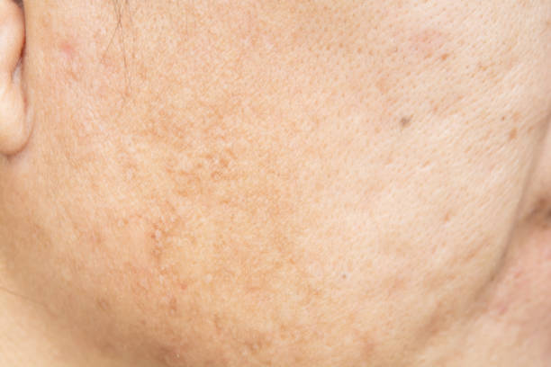 istock Pores on the face in women 1047349434