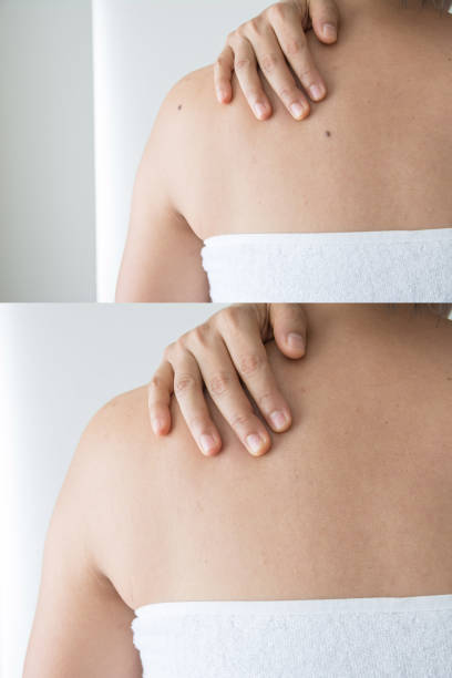 istock Moles on the women skin before and after 1047653420