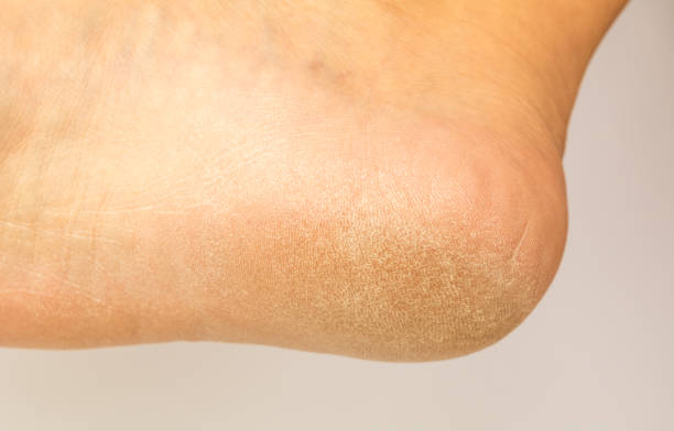 istock Bottom view close-up of a callused foot with white background. 1047743202