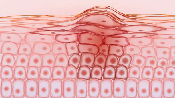 Vector illustration of Skin tissue cancerous cells, melanoma