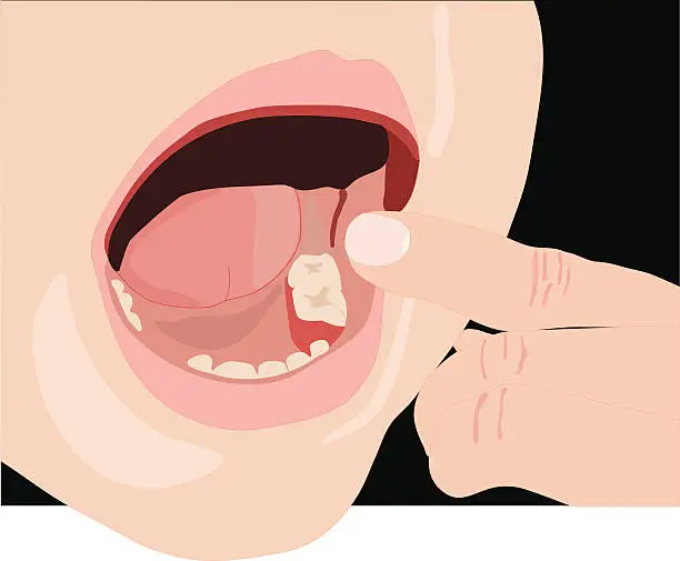 Vector illustration of Missing Tooth (Vector)