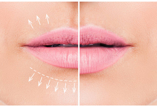 schöne rosa lippen vor und nach der füllstoff injektion kollagen, das volumen der lippen zu erhöhen. beauty-konzept. weibliche lippen, brustvergrößerung verfahren - big lips stock-fotos und bilder