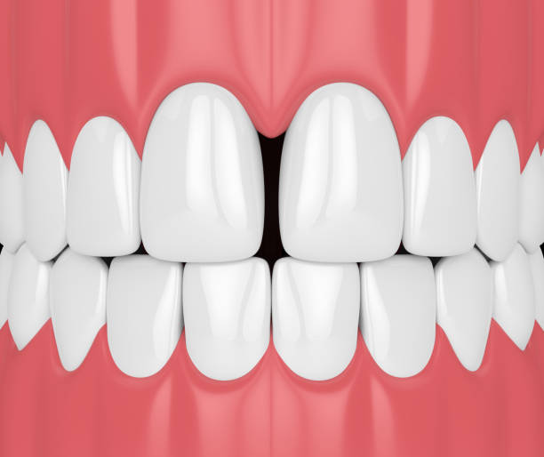 istock 3d render of teeth with diastema 1049313734