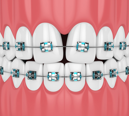 3d render of teeth with convergent diastema and braces. Divergent diastema correction concept.