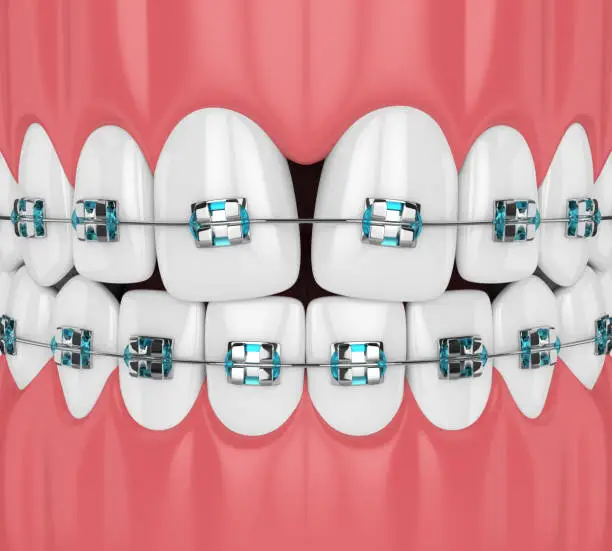 Photo of 3d render of teeth with convergent diastema and braces