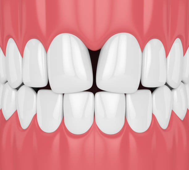 istock 3d render of teeth with convergent diastema 1049322220