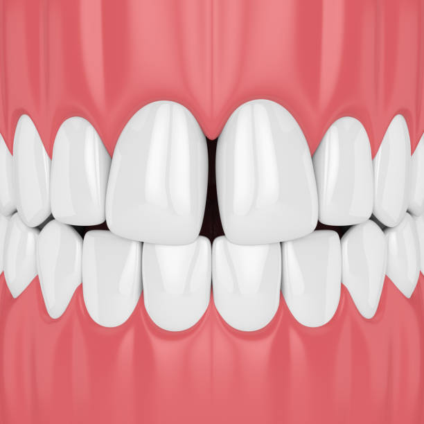 istock 3d render of teeth with diastema 1049324534