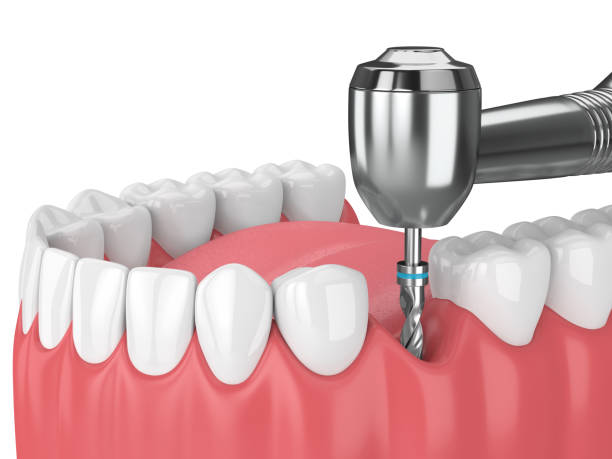 istock 3d render of jaw with dental implant drill 1049334868