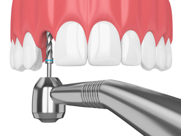 istock 3d render of jaw with dental implant drill 1049338176