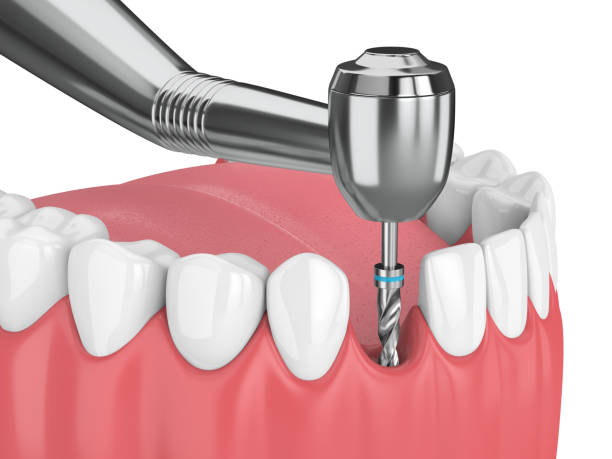 istock 3d render of jaw with dental implant drill 1049365630