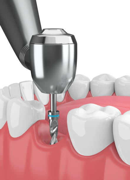 istock 3d render of jaw with dental implant drill 1049368502
