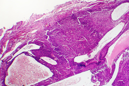 Fibrosarcoma, malignant tumor of fibroblasts, one of soft tissue sarcomas, light micrograph, photo under microscope