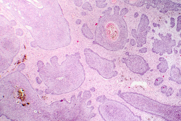기저 세포 암 종 - 기저세포암종 뉴스 사진 이미지