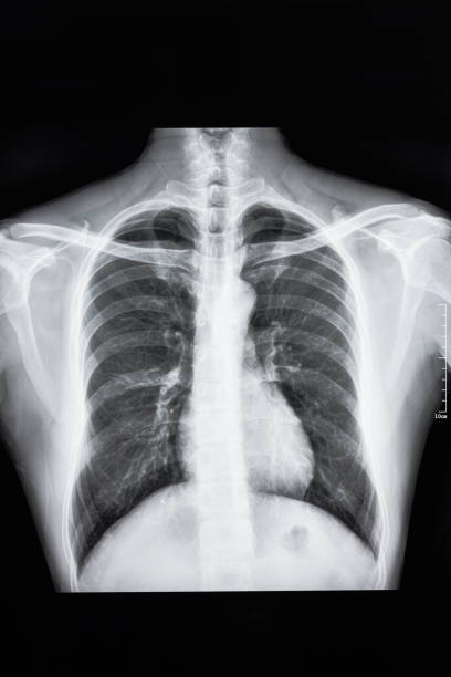 istock Chest CT scan film 1049430158