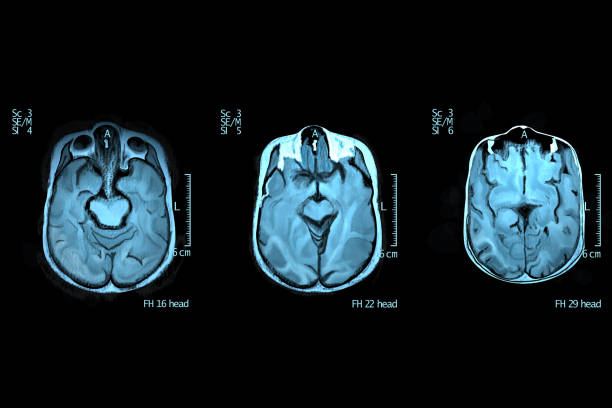 secção transversal do cérebro humano - neuroscience mri scan brain brain surgery - fotografias e filmes do acervo