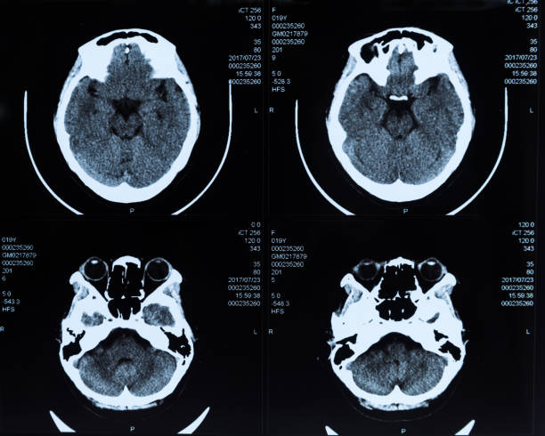 mri skan ludzkiej głowy flim - brain physical injury x ray image x ray zdjęcia i obrazy z banku zdjęć