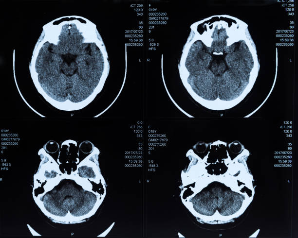 mri varredura flim cabeça humana - mri scan human nervous system brain medical scan - fotografias e filmes do acervo