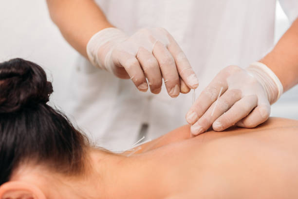 przycięty strzał kosmetologa wprowadzenie igieł na kobiety z powrotem podczas terapii akupunktury w salonie spa - acupuncturist zdjęcia i obrazy z banku zdjęć