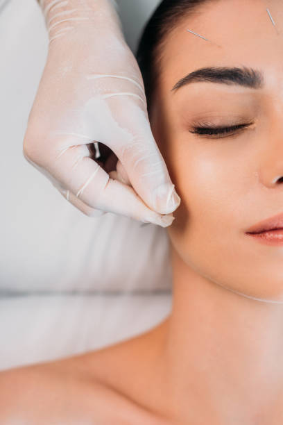 istock partial view of cosmetologist putting needles on womans forehead during acupuncture therapy in spa salon 1051100576