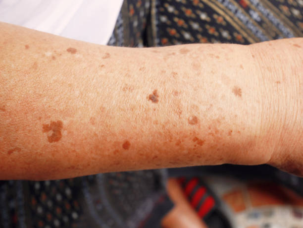 Dark spots on the skin on the arm. stock photo