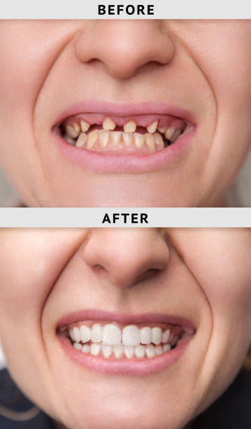 sorridi dopo e prima del processo di installazione della corona dentale - human teeth whitening dentist smiling foto e immagini stock