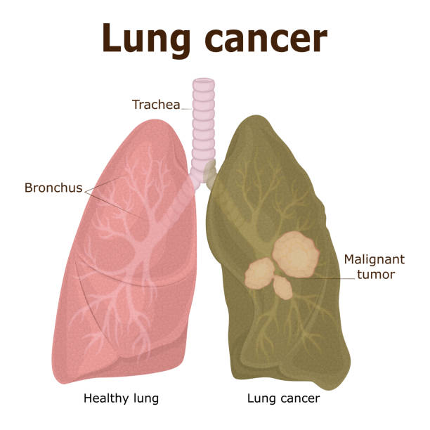 Illustration of lung cancer Illustration of a Malignant Tumor - Lung Cancer Lung Cancer stock illustrations