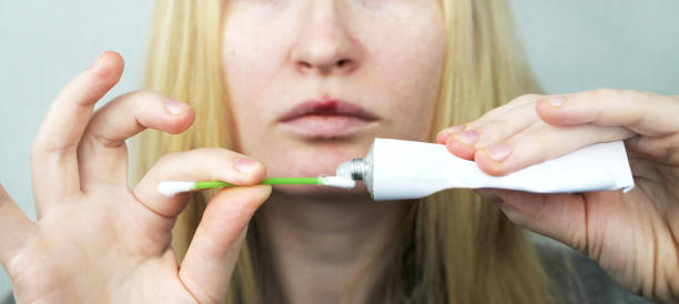 istock A woman puts on the lips ointment from herpes 1053171660