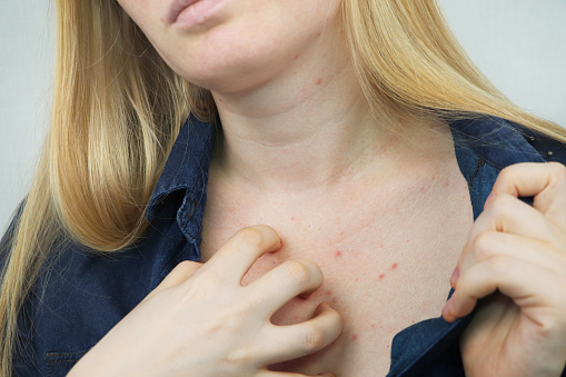 Concepto de la alergia. Mujer joven con granitos en el pecho, closeup photo