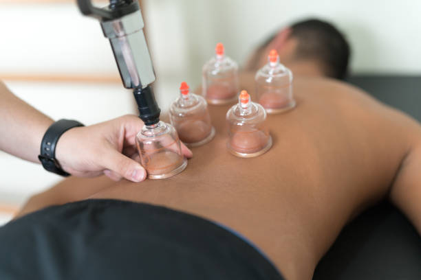 applicare la terapia di coppetto nella medicina tradizionale cinese sull'uomo indietro - acupuncture spa treatment asian culture medicine foto e immagini stock