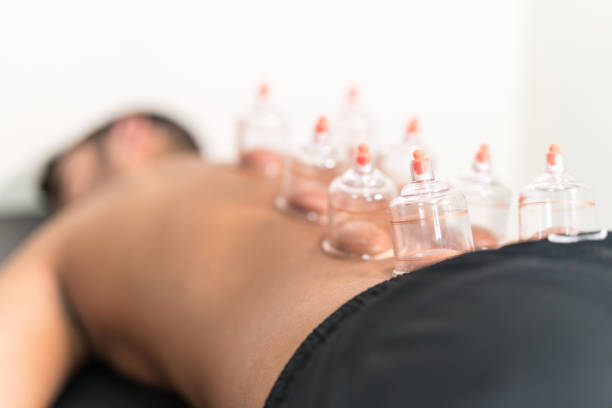 남자 뒤에 중국 전통 의학에서 받아 넣는 치료를 적용 - acupuncture cupping 뉴스 사진 이미지
