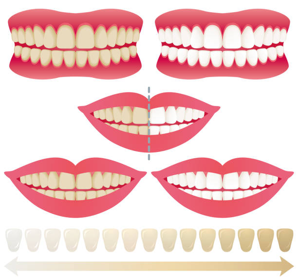 ilustraciones, imágenes clip art, dibujos animados e iconos de stock de dientes que blanquean. - dental issues