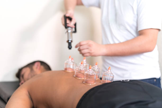 applying cupping therapy in traditional chinese medicine on man back - chinese medicine medicine ancient herbal medicine imagens e fotografias de stock