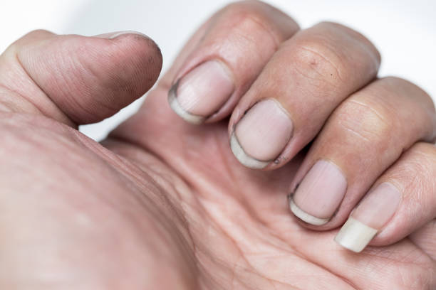 dirty finger nails unhealthy pile up germ and bacteria unclean worker hand