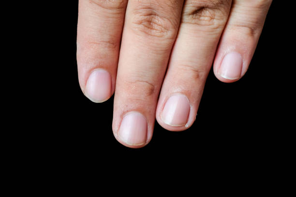 istock closeup Dermatitis detail 1054770284