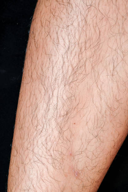istock closeup Dermatitis detail 1054773440
