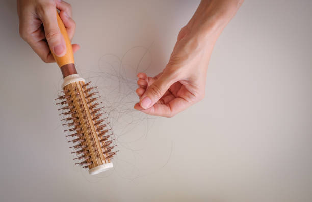 istock hair fall and lost alopecia woman problem on the comb. 1054862928