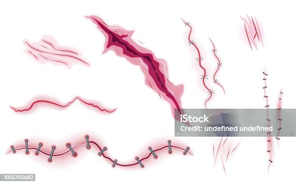 Surgical Stitches Realistic Vector Scars Bruise And Slaughter Set Isolated On The White Background Bloody Scarmedical Cutpain Of Human Bodyaccident Recovery In Hospitalcare Stock Illustration - Download Image Now