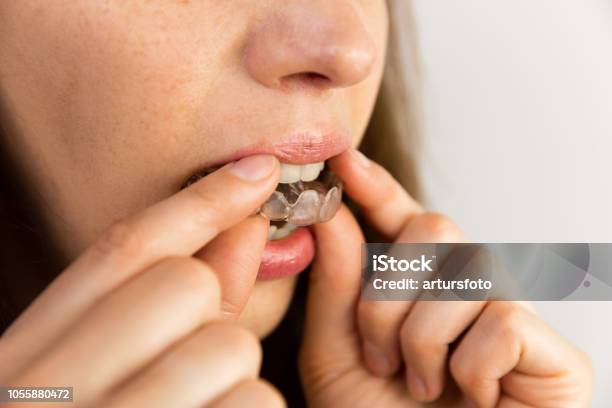 Giovane Donna Mette Allineatore Trasparente Per Il Trattamento Dentale - Fotografie stock e altre immagini di Fare la guardia