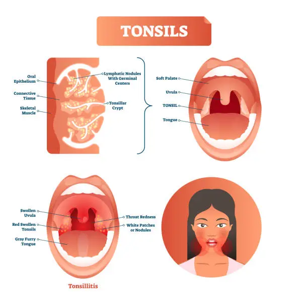 Vector illustration of Tonsils vector illustration. Tonsillitis labeled structure diagram.