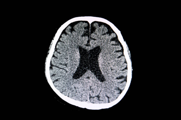 A CT scan of brain atrophy A CT scan of the brain of a patient with cerebral atrophy showing large ventricles and generalzed shrinkage of the cerebral tissue. atrophy stock pictures, royalty-free photos & images