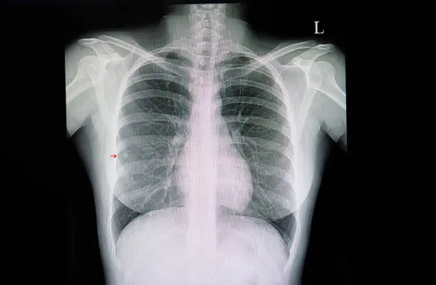 Photo of small right middle lung nodule