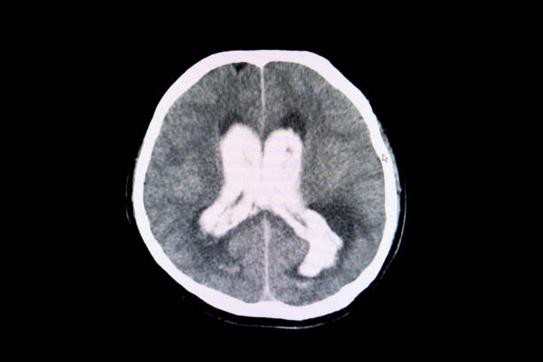 istock intracranial hemorrhage 1056146826