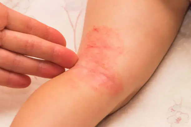 child on the leg, Allergy, fungus flakes and covered with a crust, treated with ointment