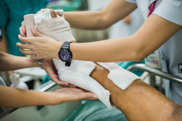 paciente com a perna quebrada e imobilizadas para tratamento no hospital. - tala - fotografias e filmes do acervo