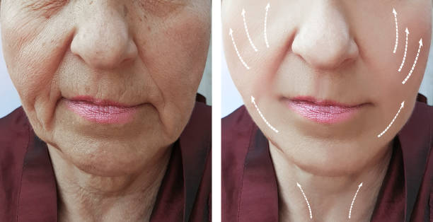istock old woman wrinkles before and after the procedure 1056437248
