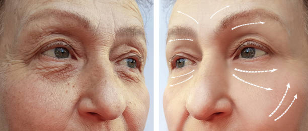istock old woman wrinkles before and after the procedure 1056459676