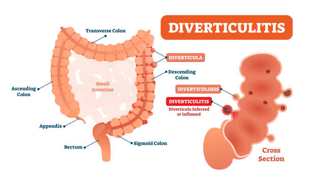 divertikulitis-vektor-illustration. beschrifteten diagramm mit seiner struktur - menschlicher dickdarm stock-grafiken, -clipart, -cartoons und -symbole