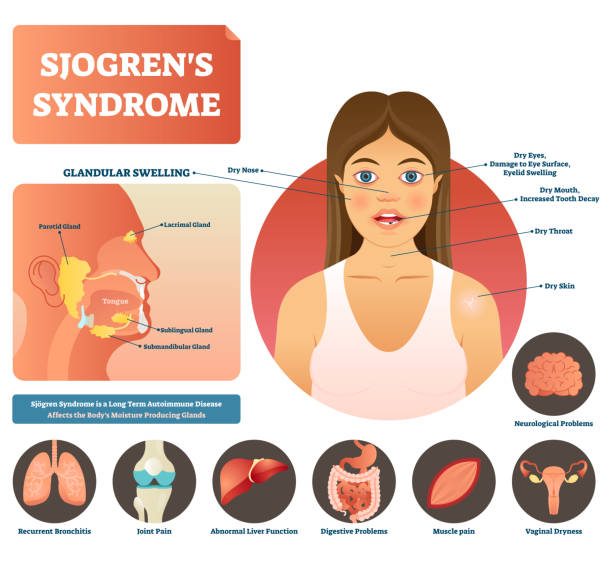 illustrations, cliparts, dessins animés et icônes de illustration vectorielle de sjögren syndrome. maladie auto-immune corps sec. - sublingual