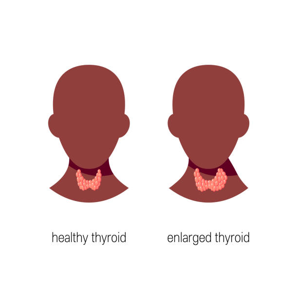 Hyperthyroid Animation 870+ Hyperthyroidism Illustrations, Royalty-Free Vector Graphics & Clip ...