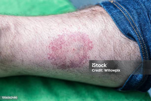 Circular Bulls Eye Tick Bite Skin Rash Stock Photo - Download Image Now - Lyme Disease, Tick - Animal, Bug Bite
